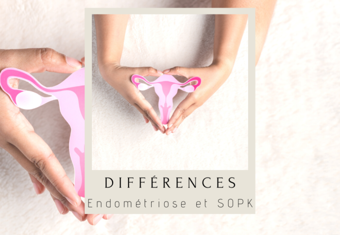 Endométriose et SOPK : les différences